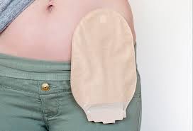 Ostomy bag